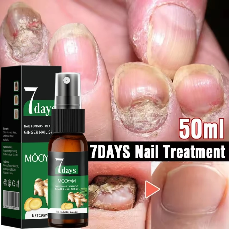 

7 Days Nail Fungus Treatments Serum Toe Nail Fungal Removal Essence Anti-Infection Onychomycosis Paronychia Nail Care Products