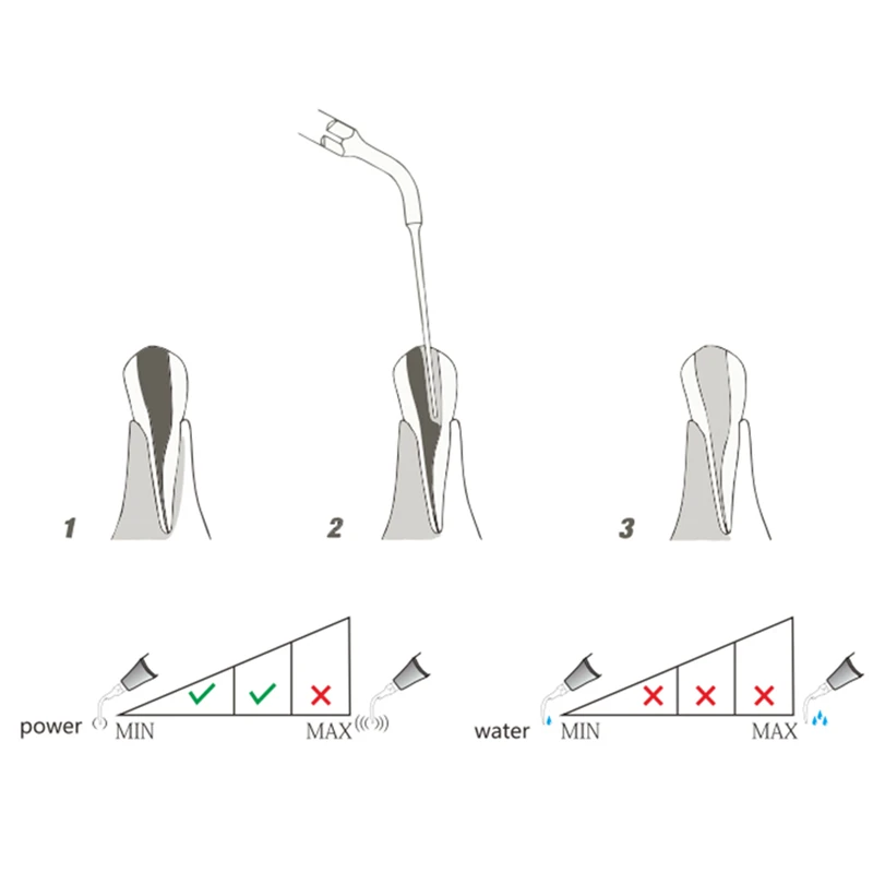 Scaler ultrasonik Tip E4 ujung endodontik gigi untuk EMS/pelatuk Scaler penghapusan Handpiece mengisi dan bahan asing