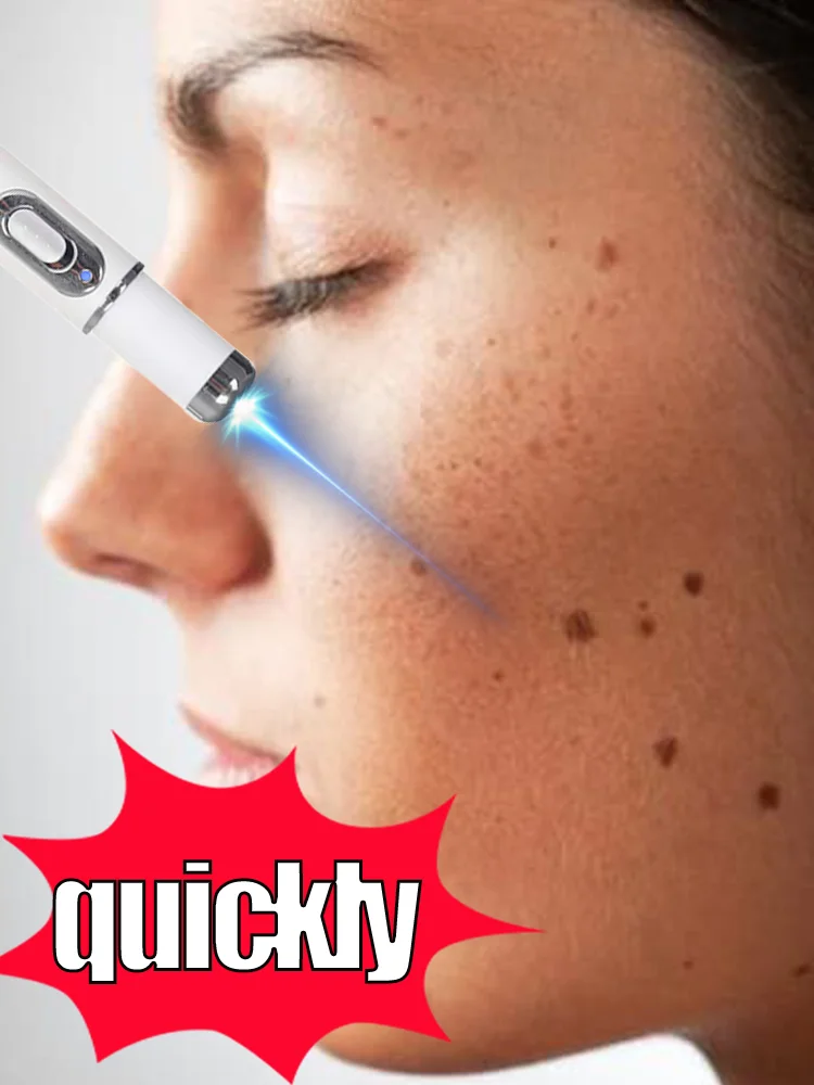 

"Warts blue light tool, more discounts on sets "