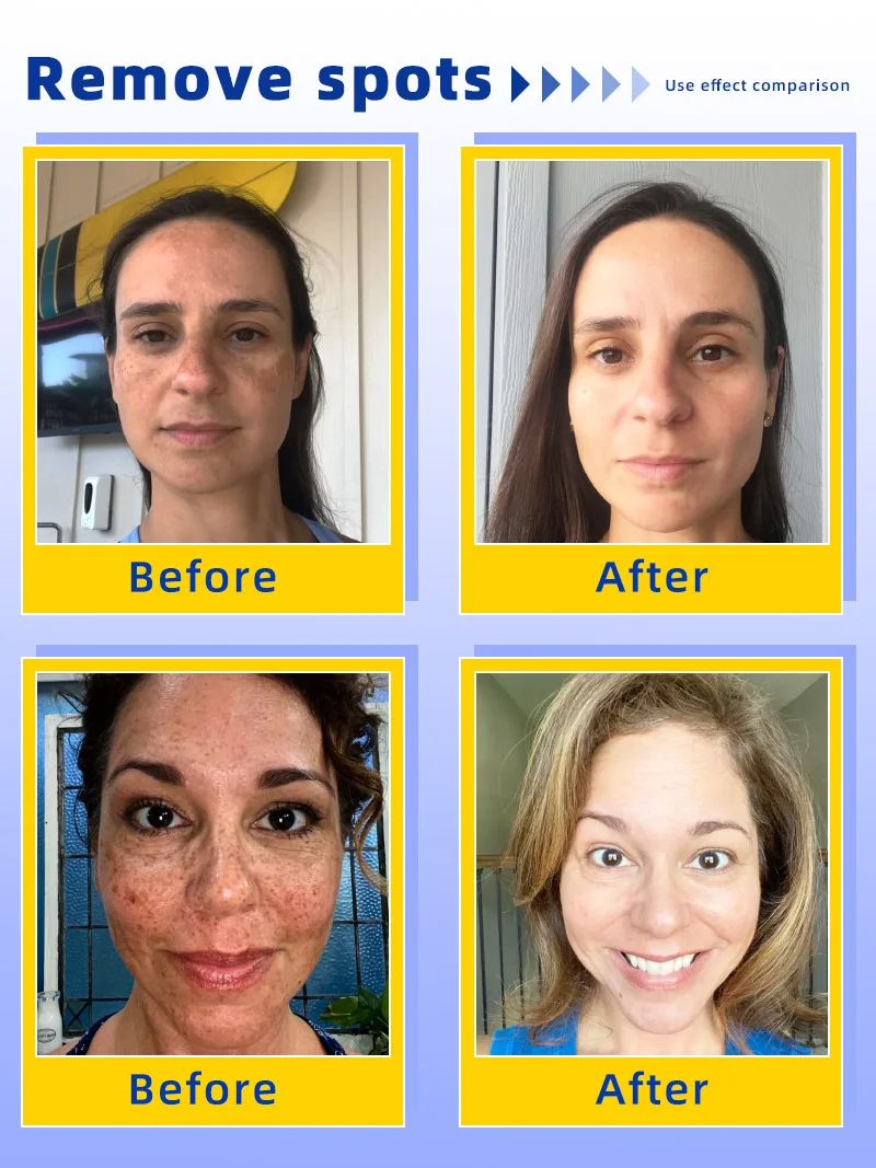 تفتيح النمش الكلف، البقع الداكنة للوجه