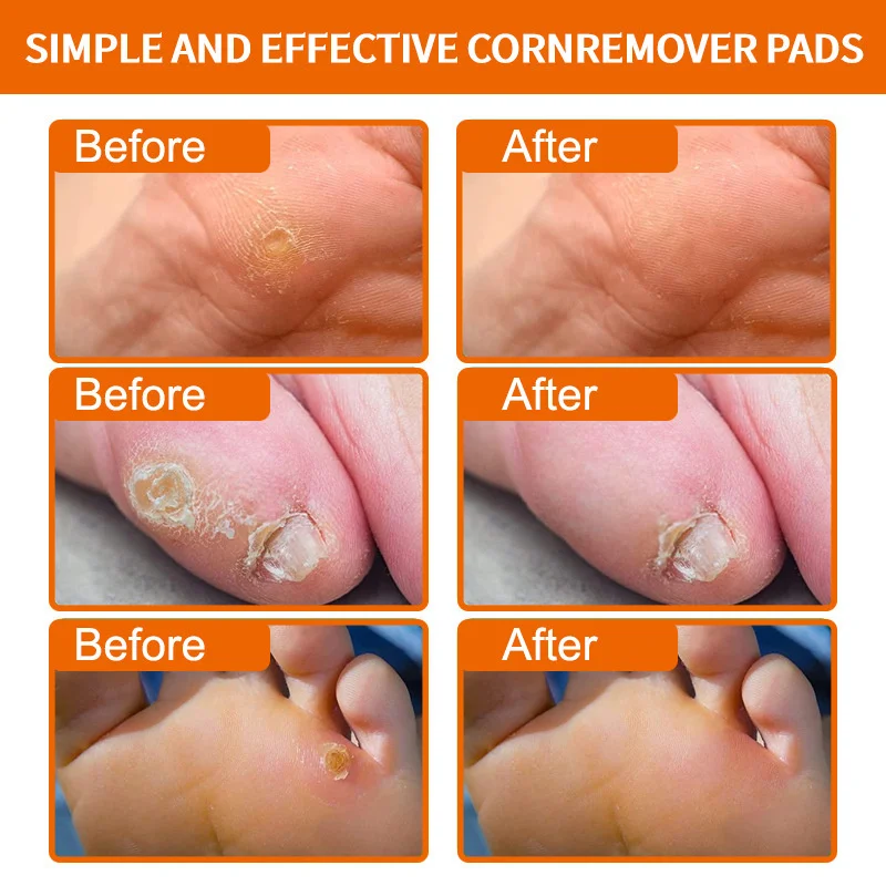 Foot Toe Corn Pad Remover, Callus Almofada Pads, Adesivo Removedores de Pés, Salicílico Calos, Fast Step, Dedo Tratamentos, Ácido