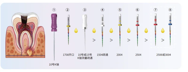 Dental Neue Rotary Regenbogen Dateien Superfiles Universal Nadel Zubehör Endodontie Für Wurzel Kanal Dateien Reinigung Zahnarzt Verwenden – Detail 4