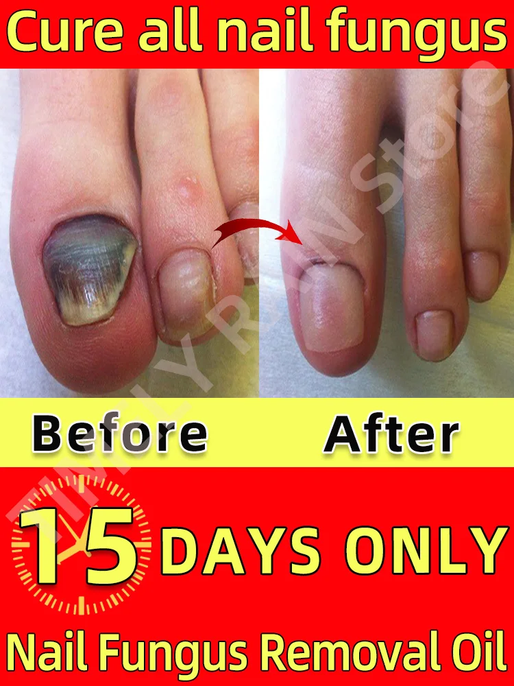 Hot Selling Laser Product For Solving Nail Problems