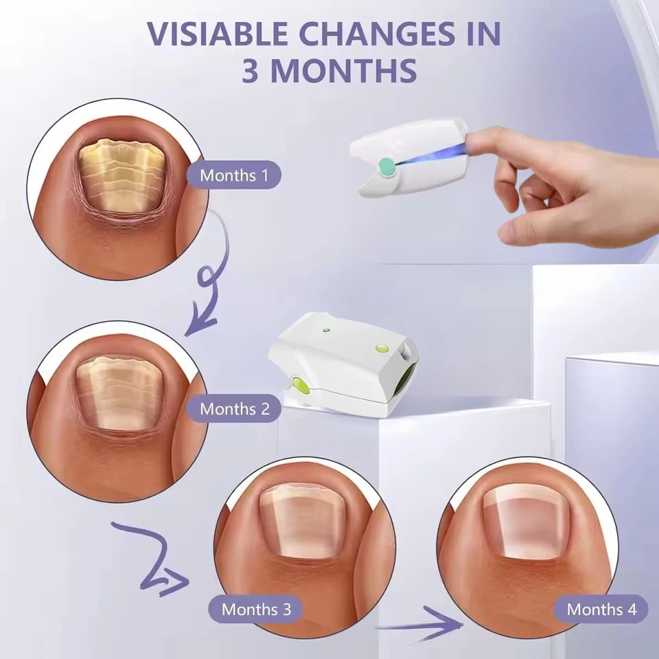 

Инструмент от онихомикоза, портативное лазерное устройство для терапии грибка ногтей, ремонт ногтей на ногах, противогрибковые инструменты, зарядка через USB