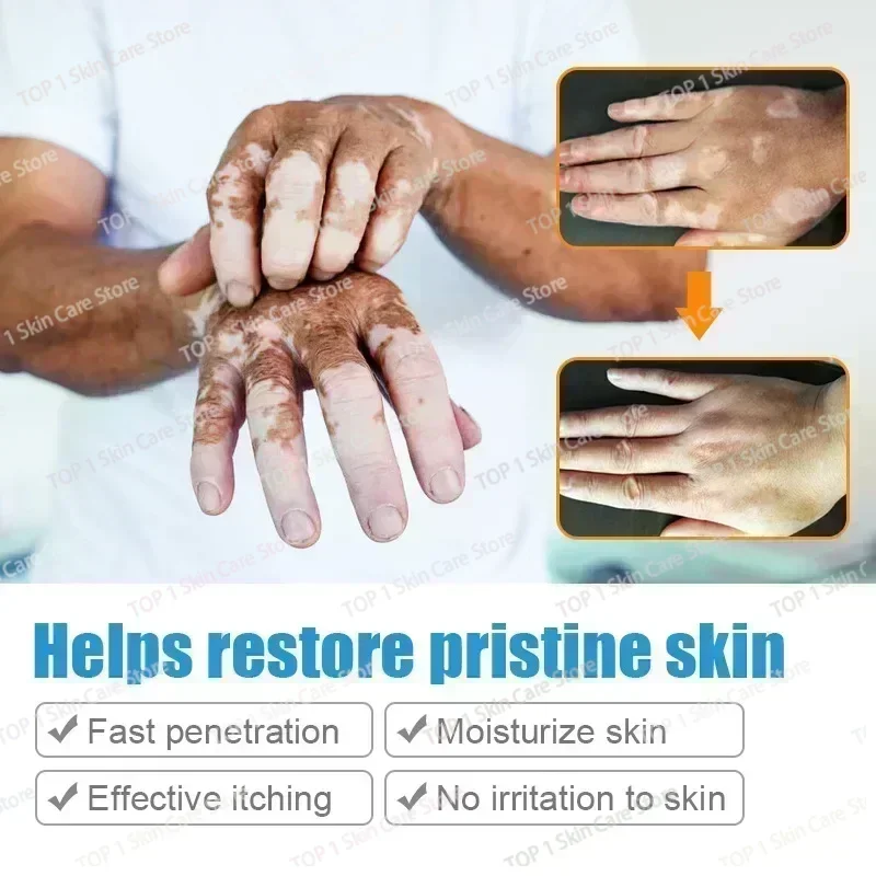 สารสกัดจากสมุนไพร Vitiligo Ointment ลบกลากสีขาว Spot Removal ผิว Vitiligo กําจัด Vitiligo Treatment 0903