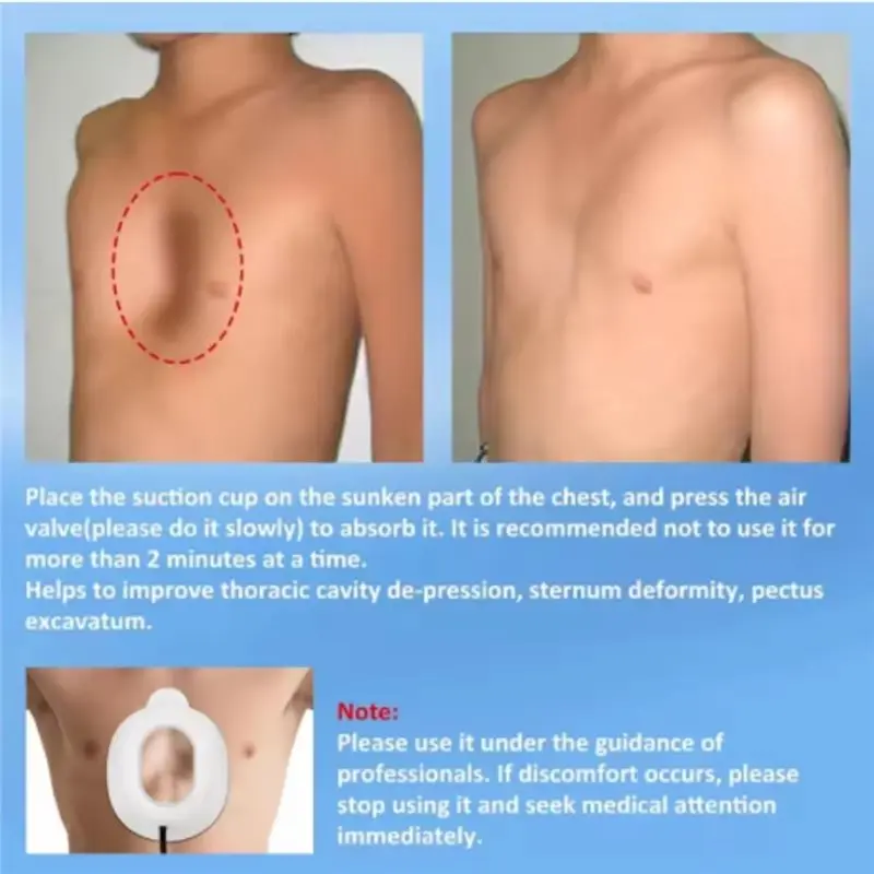 Thoracic Repair Pectus Excavatum Correction Cup Adult Children Sternum Rib Depression Deformity Physical Orthotic Tool M