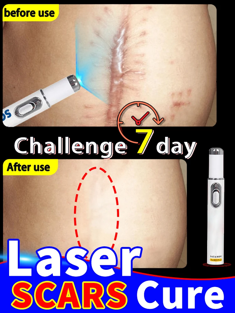 

Laser keloid repair