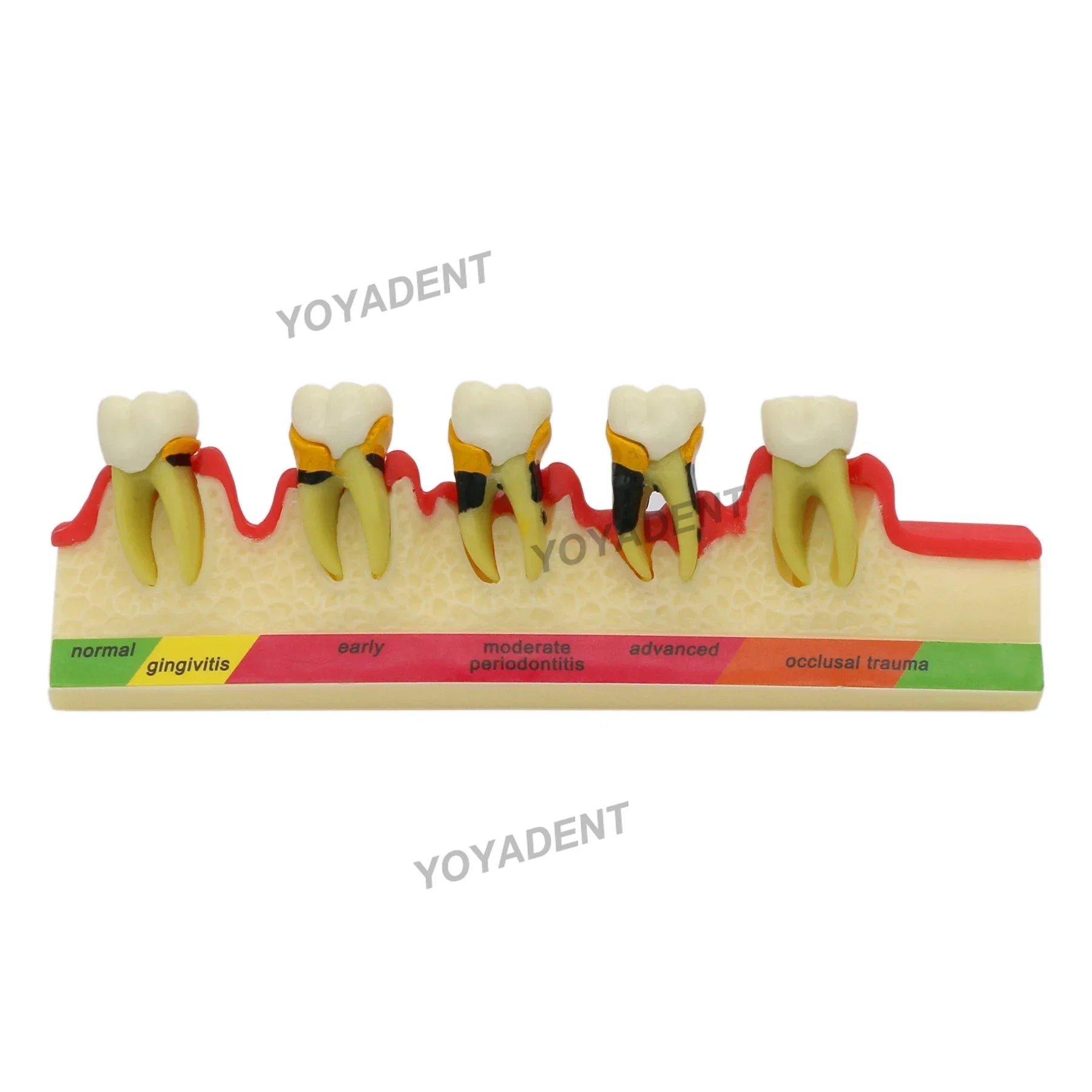 Model zębów Model stomatologii Model nauczania Stomatologiczne choroby przyzębia Patologiczne 5-stopniowa postęp Dentysta Pacjenci Komunikacja