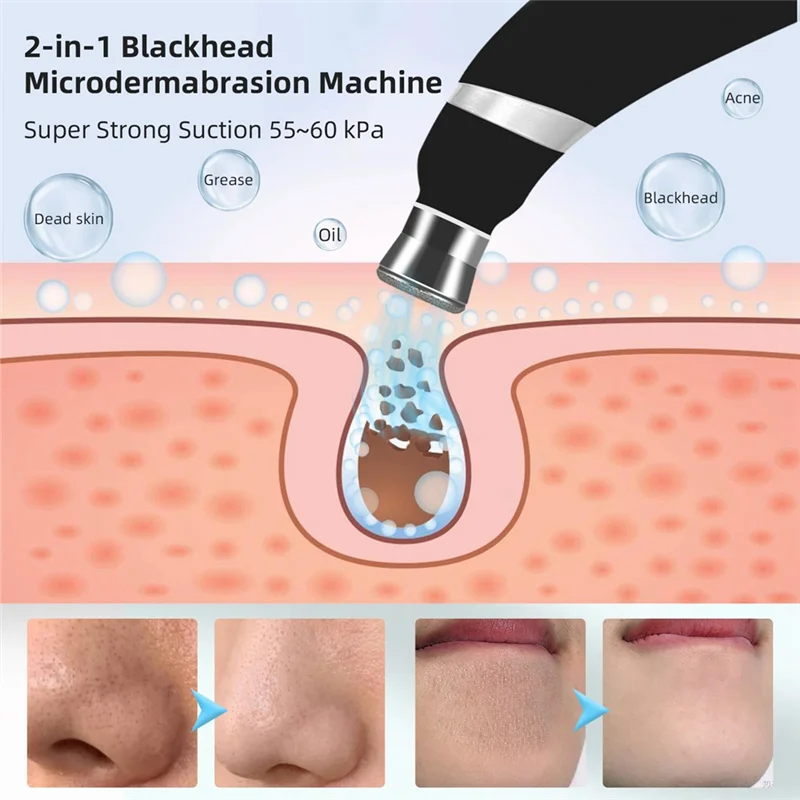 เครื่องขัดผิวหน้าแบบพกพา A02V-Blackhead Removal กำจัดสิวเสี้ยนด้วยระบบไมโครเดอร์มาเบรชั่น พร้อมชุดอุปกรณ์