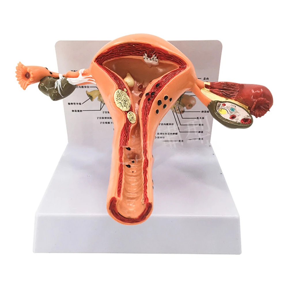 

Medical Props Model Human Female Pathological Uterus Ovary Model Anatomical Disease Pathology Medical Lesion ForBiology Teaching