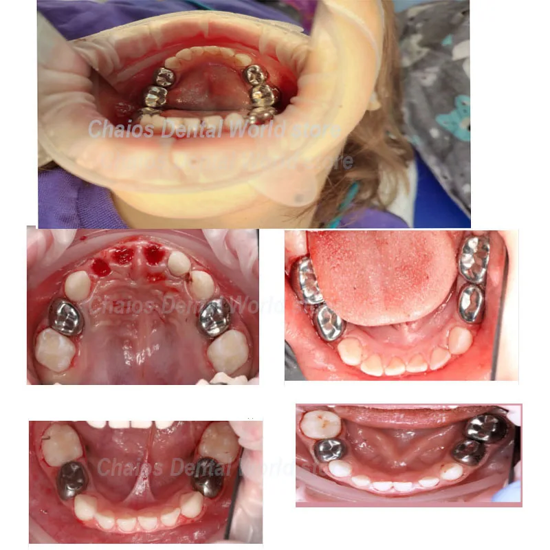 5 sztuk/pudło ze stali nierdzewnej dentystyczna metalowa korona dziecięca pierwotna molowa tymczasowa ochrona zębów trzonowych 1/2 D2-D7/E2-E7