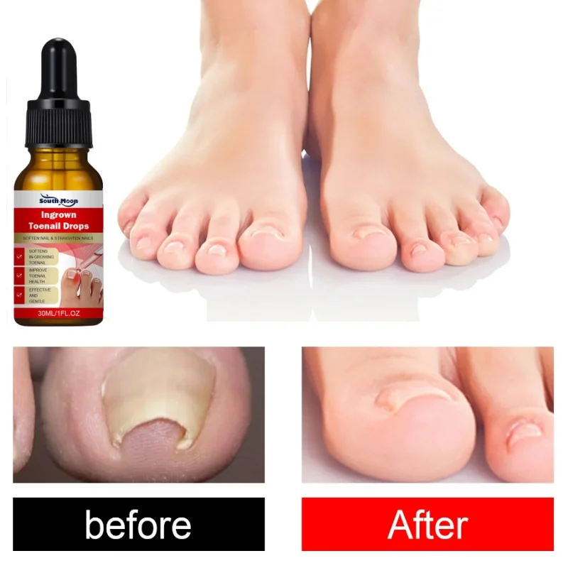 Nail fungal Treatment Serum Foot Fungus Remedy Removal Products Anti Infection Onychomycosis Paronychia Repair Gel Care 30ml