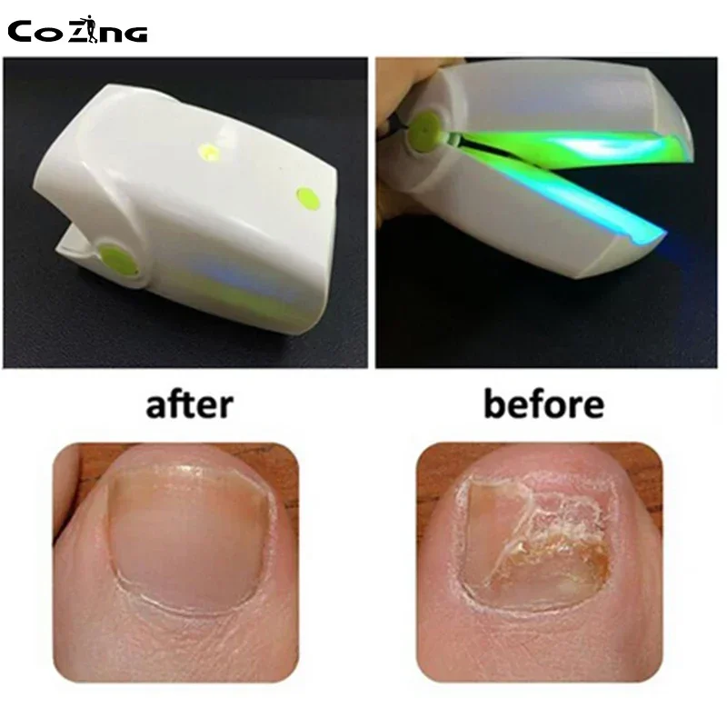 Nail Fungus Laser Device Fungal Nail Treatment Repair Onychomycosis Toenail Fingernail Removes Pedicure Foot Care Fungi Ingrown