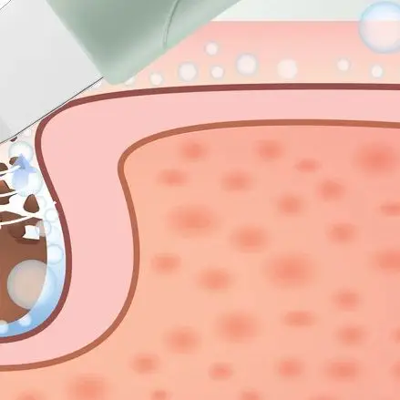 黒ずみ除去フェイススパチュラ振動フェイススキンスクラバーフェイシャルディープクリーニングツールピーリングスキンケアツール毛穴クリーナー