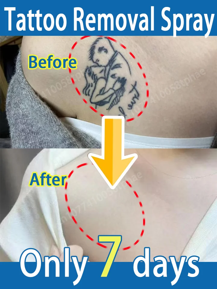 

Wʀɪɴᴋʟᴇ-ғʀᴇᴇ ᴀɴᴅ ᴘᴀɪɴʟᴇss, sᴋɪɴ ʀᴇɢᴇɴᴇʀᴀᴛɪᴏɴ,Tattoo removal spray