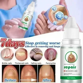 ⁿⁱᶜᵉ Fungal Nail Treatment Essence Oil Nail Fungus Repair Toenail Fingernail Treatment Onychomycosis with Mushrooms