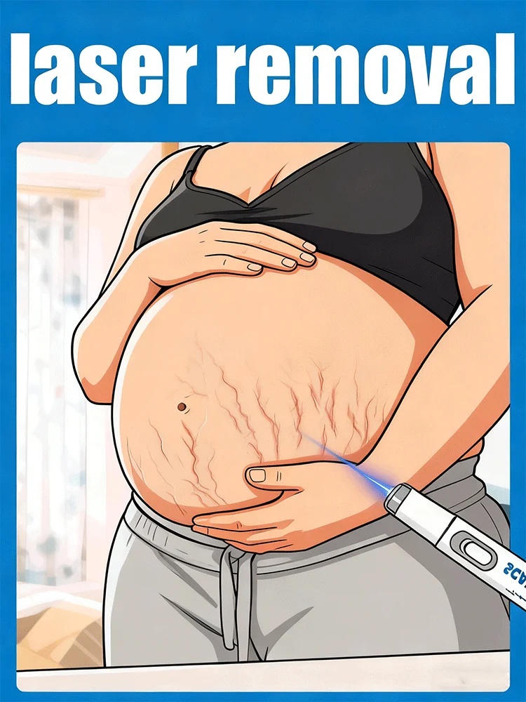 Herramientas para el cuidado de la piel posparto Productos para estrías corporales