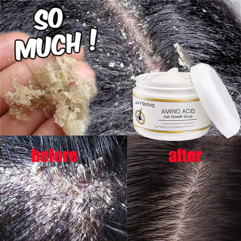 

Fast Anti Exfoliating Scrub Remove Dandruff Anti Itching Treatment Seborrheic Scalp Oil Control Cleansing Repair Scalp Care 50g