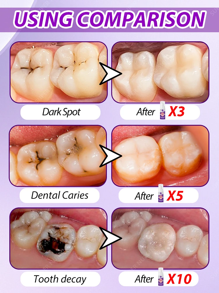 Réparation de la carie dentaire, traitement des caries, anti-cavités