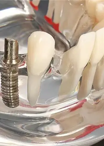 

Dental Implant Model Tooth for Dentist Training Teaching Study Tool Dental Disease Simulation Teeth Anatomy Replica
