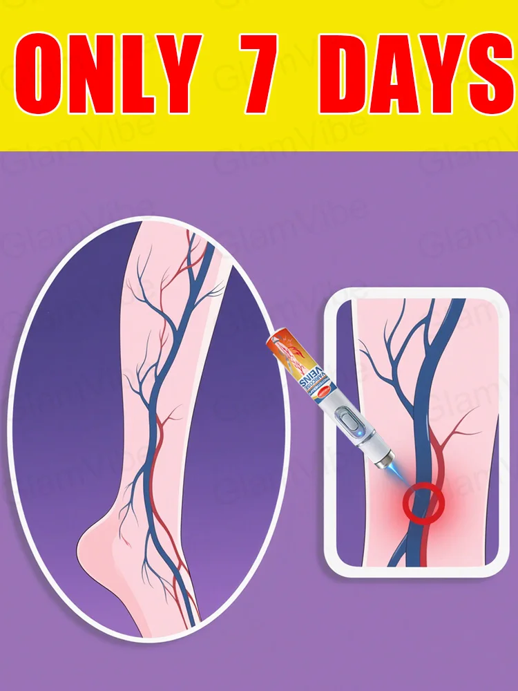 

Generation-2 Laser Says Goodbye To Spider Legs Varicose In 7 Days