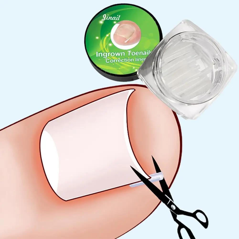 1-100PCS Eingewachsene Zehennagel Korrektur Ultra-dünne Nagel Behandlung Elastische Patch Aufkleber Richt Nägel Nut Eingewachsene Corrector – Detail 4