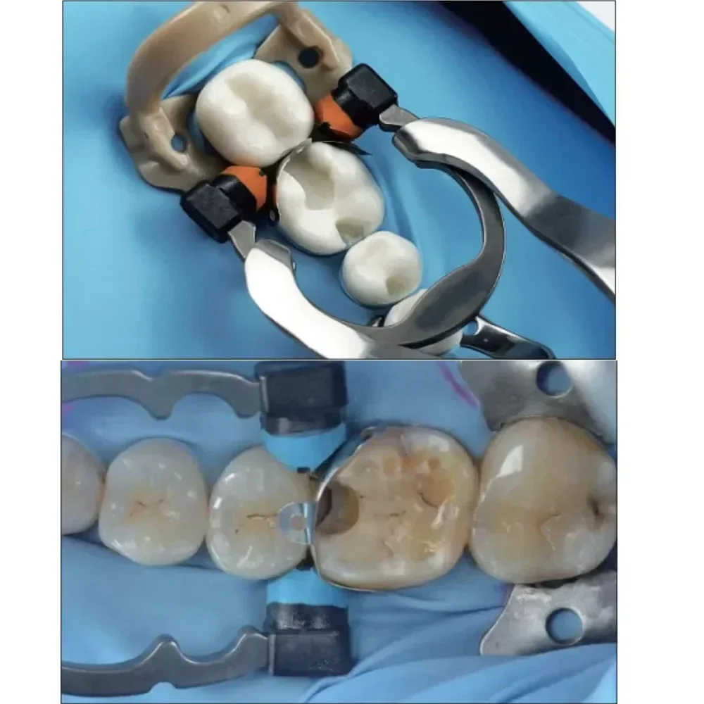 Dental segmentowy system matrycowy A3 segmentowe opaski matrycowe M4 diamentowe kliny nikiel tytanowe pierścienie ortodontyczne akcesoria