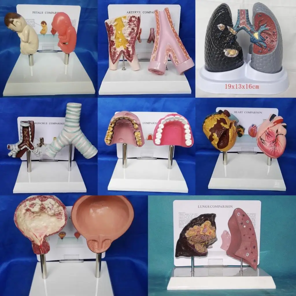 Human normal viscera smoking diseased organs contrast heart lung bladder blood vessels oral trachea fetus