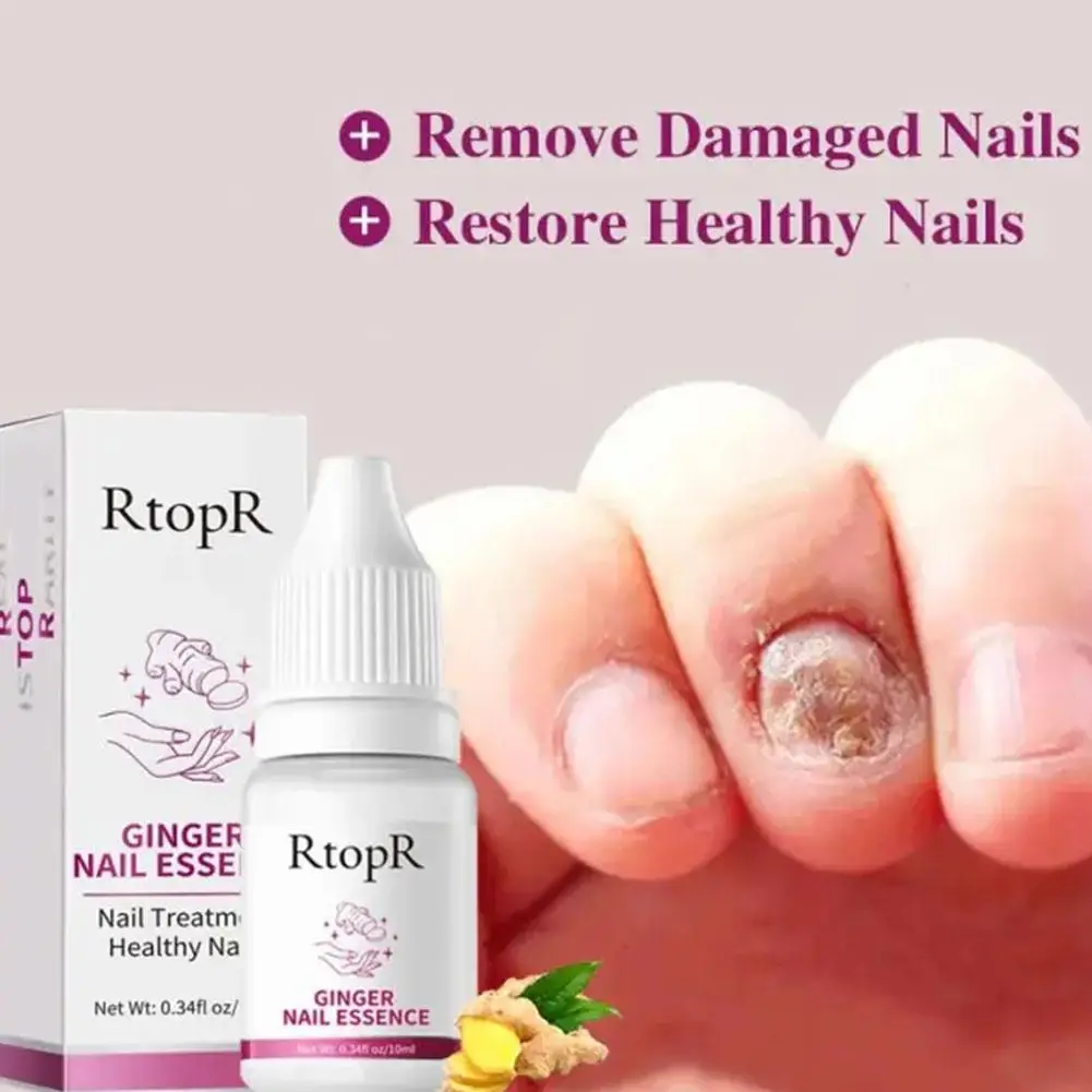 Ginger Nail Fungus Treatment Repair Armor Sterilization Tool Remover Care Beauty Treatment Health Onychomycosis Nail S9E7