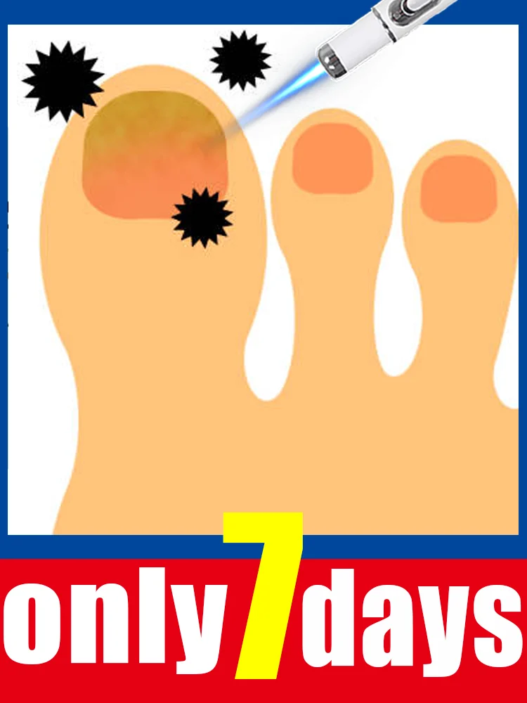 

Инструмент для очистки ногтей 2025 года. Технология грибка второго поколения. Изменение ногтей. Попрощайте проблемы с ногтями.