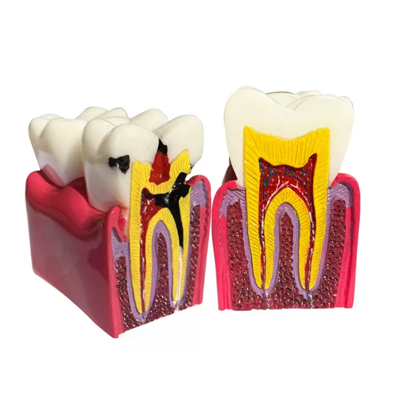 

Стоматологическая модель картофеля, заболевания зубов, стоматологическая модель для стоматологической демонстрации, обучающая модель, учебное пособие, украшения для клиники