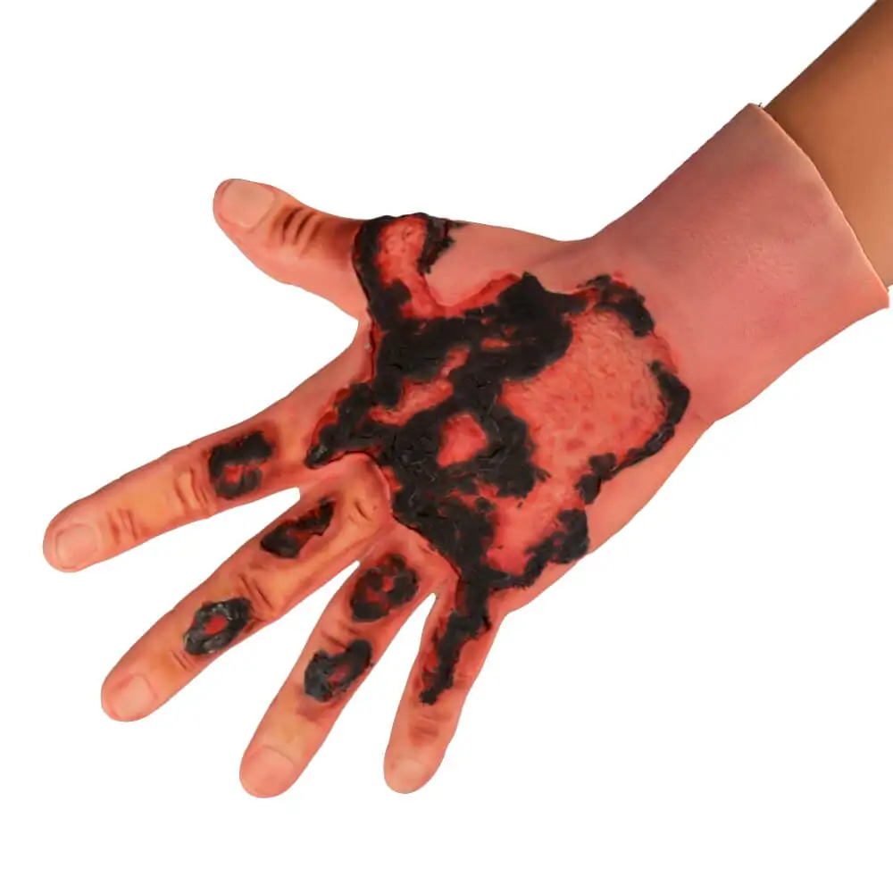 Ultrassist Hand Burn Wound Trainer Wearable Silicone Glove Simulate 3rd Degree Burn Wound for Packing Training Medical Education