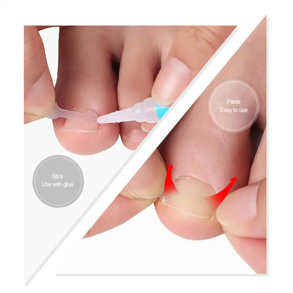 Gereedschap Pedicure Patch Orthotische Correctie Sticker Nagel Correctie Tabletten Teennagel Ortho Sticker Ingegroeide Teennagels Stickers