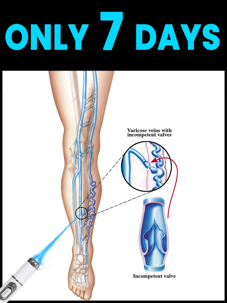 

Varicose vein pain relief, a hot-selling varicose vein blue light tool set for 2025, a leg care tool