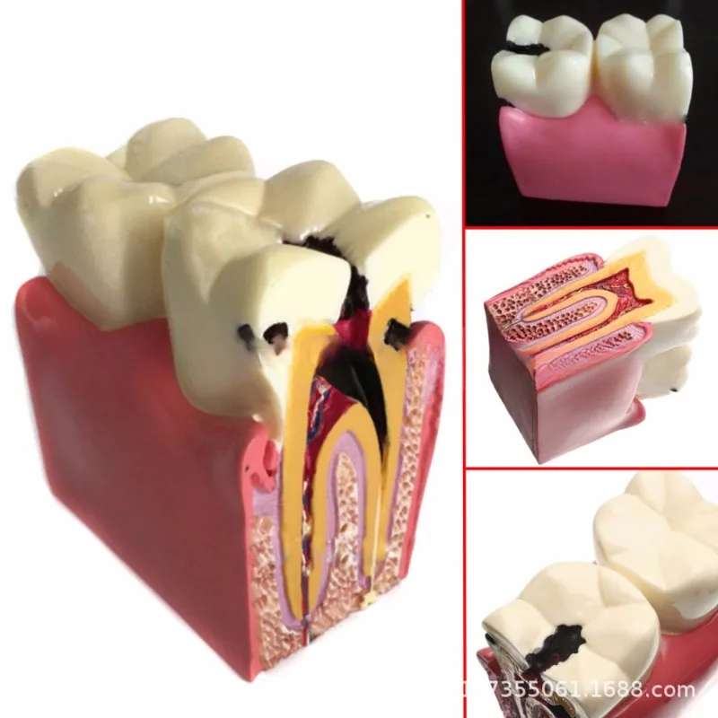 

Dental Model Teeth 6 Times Caries Comparison Model Pathology Teaching Communication Caries Section Demonstrated Dental Model New