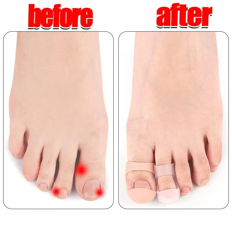 مرونة شفافة واقي إصبع القدم تنفس المضادة للاحتكاك أداة العناية بالقدم يمنع ظهور بثور قبعات الاصبع سيليكون تو يغطي