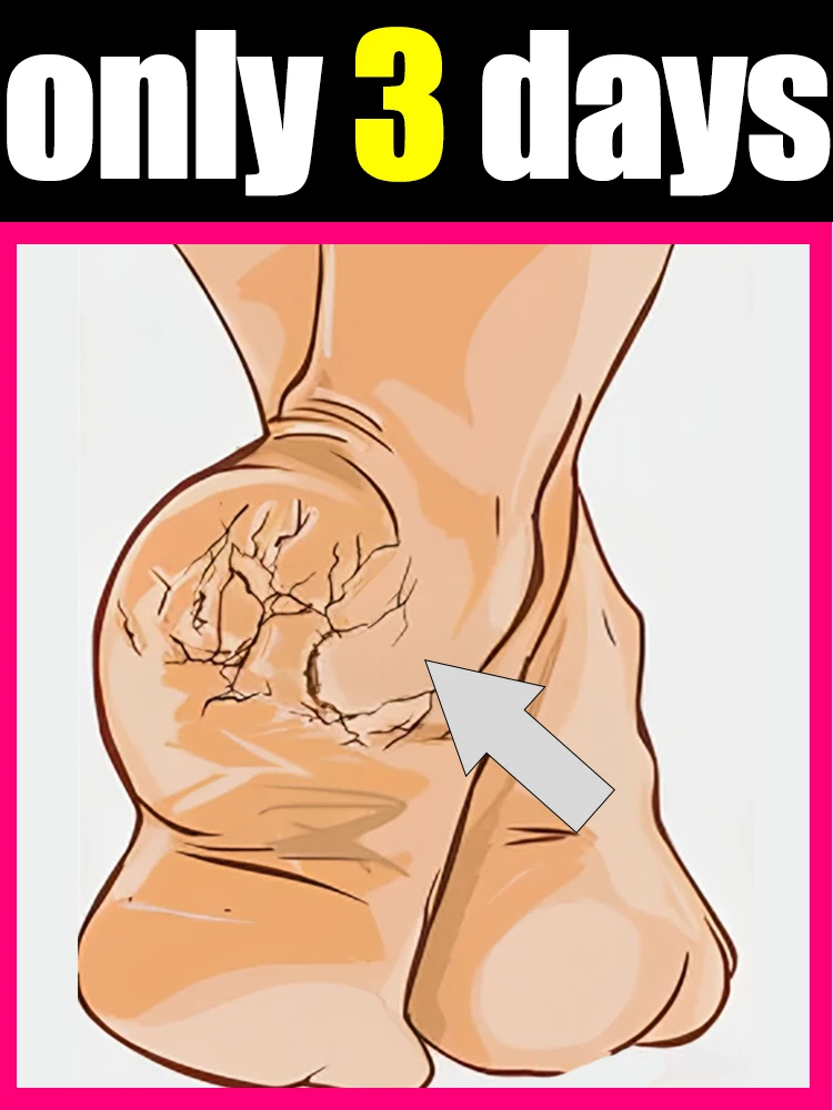 

2025 Hot Prevents chapping Dry flaky skin Cracked heels chilblains Nursing cream Contains squalane for moisturizing in winter