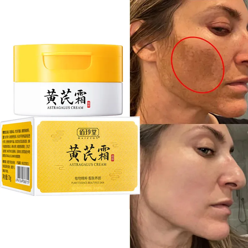 

Astragalus Freckle Whitening Cream Black Dots Melasma Remover Anti Brown Stain Lighten Pigmentation Moisturizing Skin Care Korea