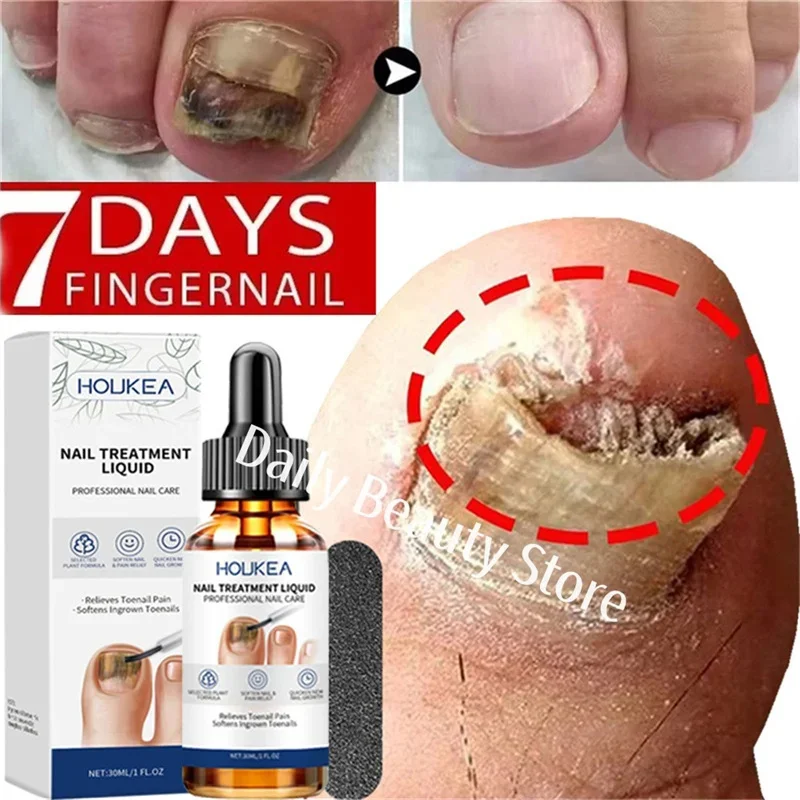 

Nail Fungus Treatment Serum Foot Repair Liquid Toe Nails Fungal Removal Gel Anti Infection Paronychia Onychomycosis Cream 30ml