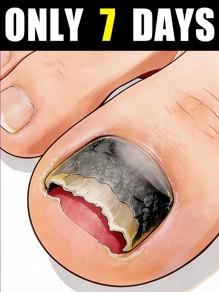 

Gentle and non-irritating， ᴱˡⁱᵐⁱⁿᵃᵗᵉ ᶠᵘⁿᵍᵘˢ ᵃᵗ ᔆᵒᵘʳᶜᵉ！