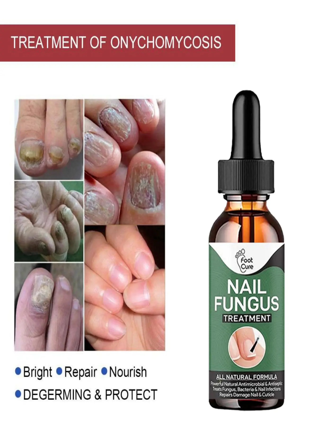 Nail Fungus Treatment Feet Care Essence Nails Foot Repair Toe Nail Fungal Removal Onychomycosis Gel Anti Infection Paronychia