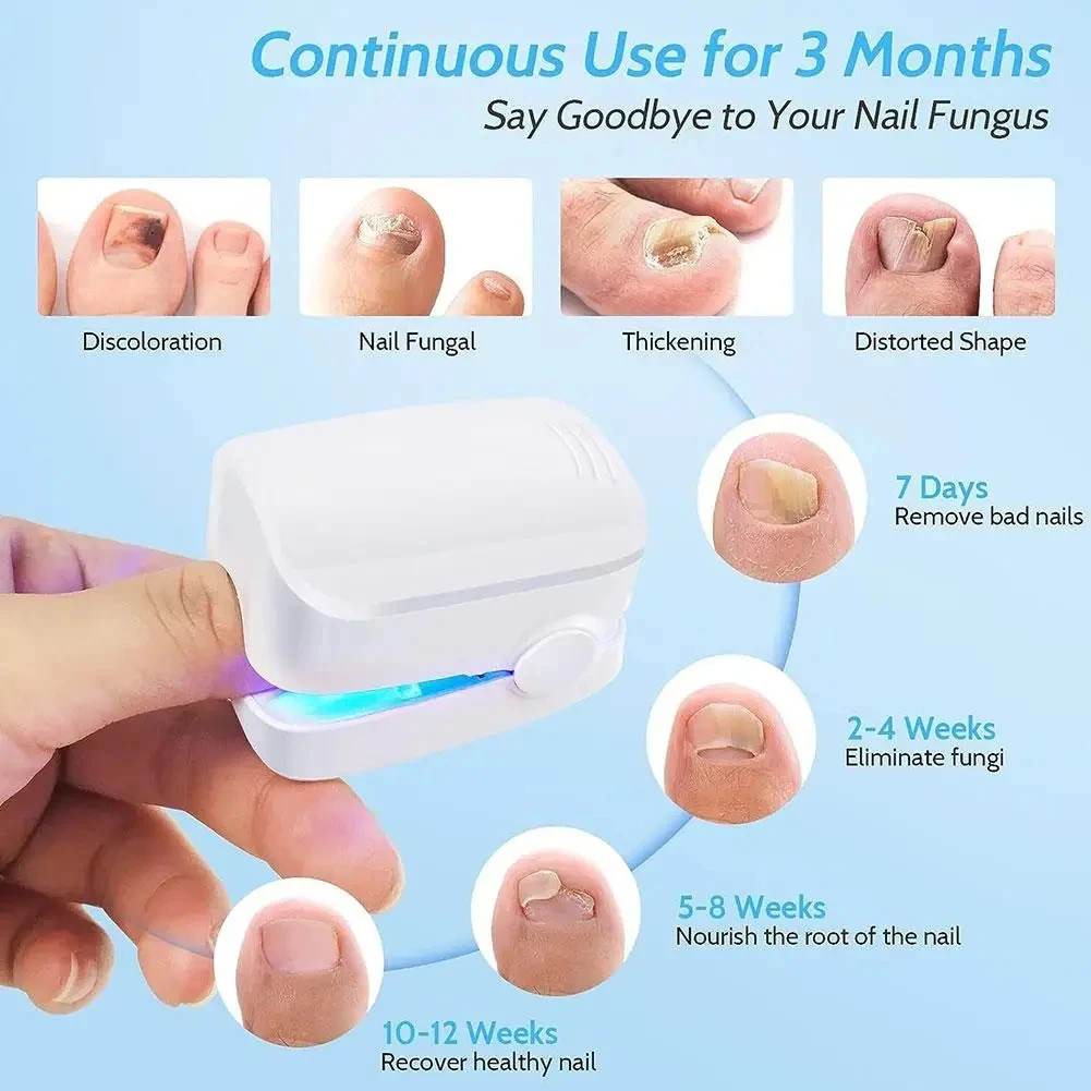 Appareil de traitement au laser des champignons des ongles, réparation des ongles des orteils, élimination efficace des champignons, onychomycose, huile essentielle