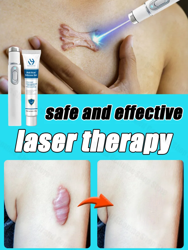 

Laser therapy Keloid scar