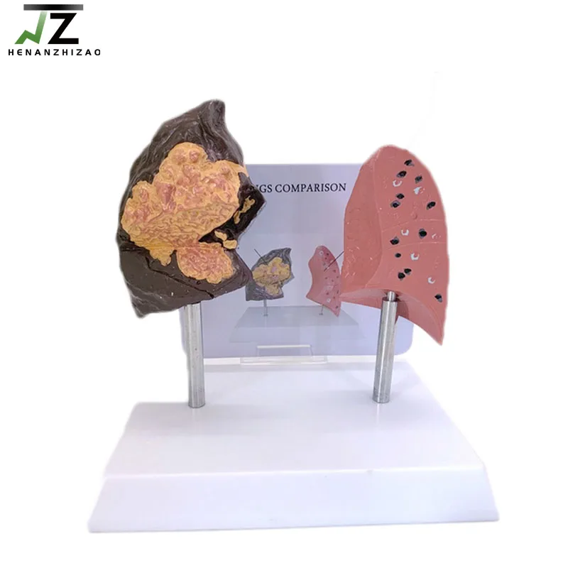 

Respiratory System Human Anatomy Healthy and Smoking Pathological Lung Comparison Model