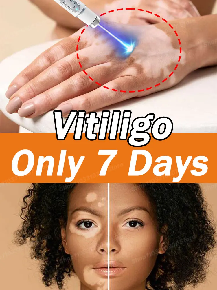 Improve Skin Pigmentation and Reduce White Spots Vitiligo Cream