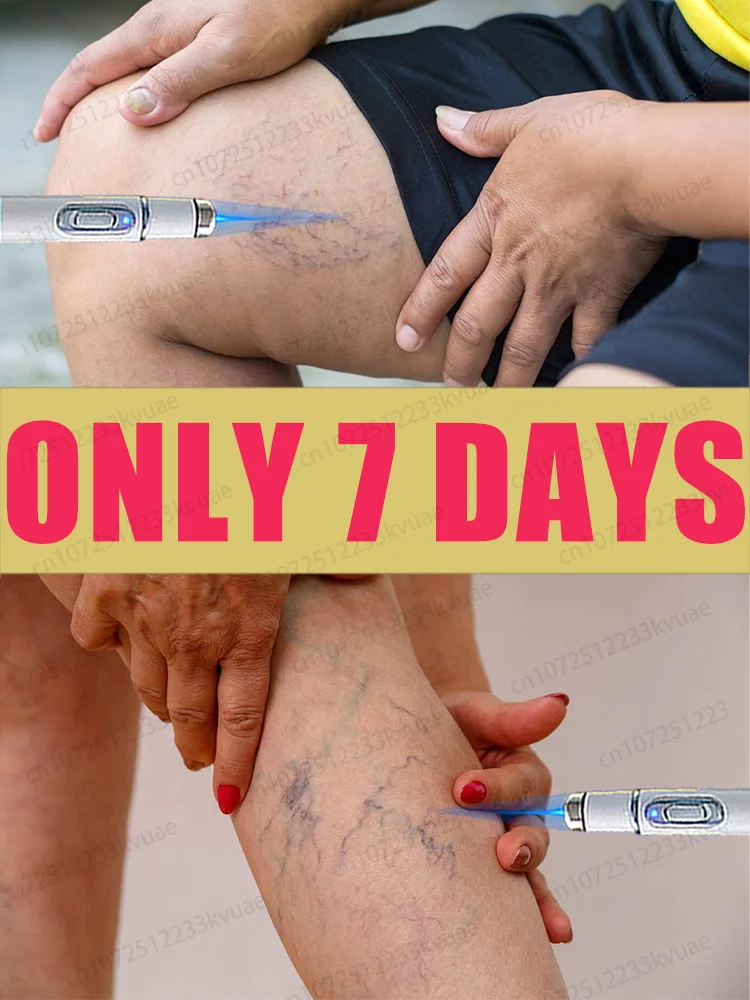 

Lᴀsᴇʀ ᴠᴇɪɴ ᴘᴇɴ Rᴇᴍᴏᴠᴇ ᴠᴀʀɪᴄᴏsᴇ ᴠᴇɪɴs ғʀᴏᴍ ᴛʜᴇ ʙᴏᴅʏ