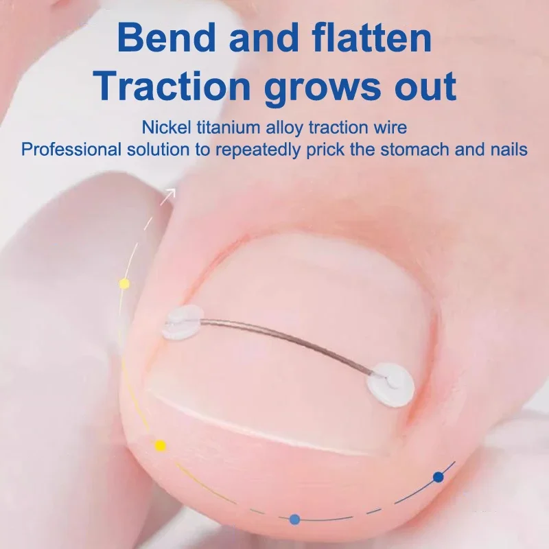 Cura delle unghie Strumento per la correzione dell'unghia del piede incarnita Trattamento delle unghie dei piedi incarnite Adesivo patch elastico Raddrizzamento Clip Brace Pedicure Too