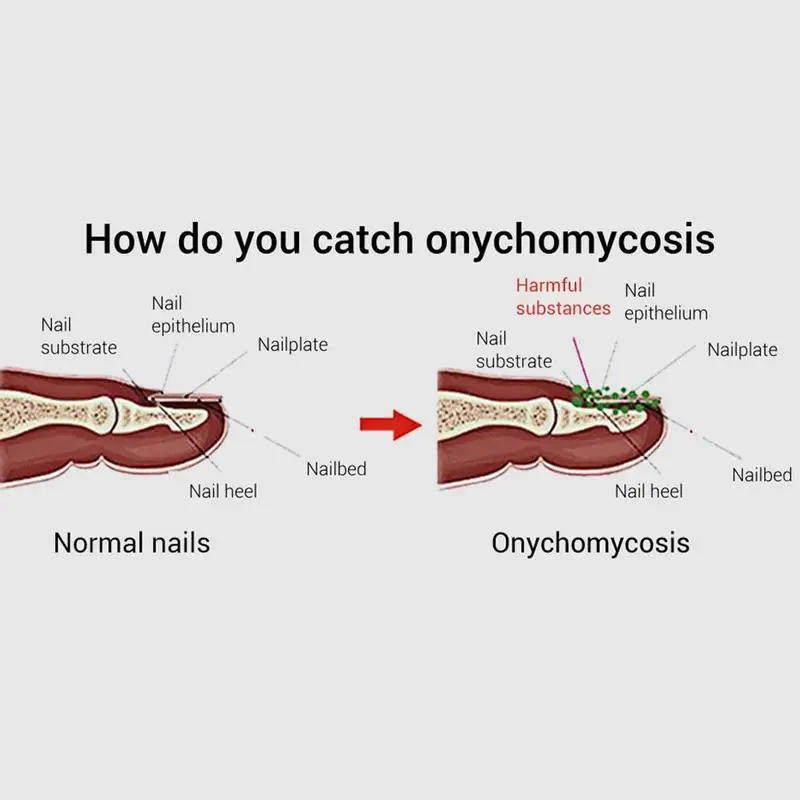 15ml LANBENA Fungal Nail Treatment Feet Care Essence Fungus Infection Paronychia Healthy Serum Repair Removal Onychomycosis T4N4