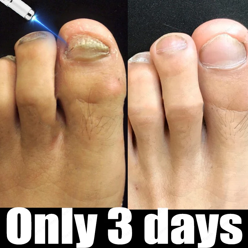 

Hot-selling nail protectorᴮˡᵘᵉ ˡⁱᵍʰᵗ ᵗʰᵉʳᵃᵖʸ ᶜᵃⁿ ᑫᵘⁱᶜᵏˡʸ ᵗʳᵉᵃᵗ ᵒⁿʸᶜʰᵒᵐʸᶜᵒˢⁱˢ‧