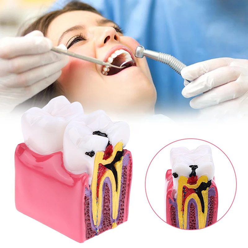 

6 Times Dental Caries Model Disease Teeth Dental Model For Dental Demonstration Model Dentist Teaching Dental Lab Oral Research